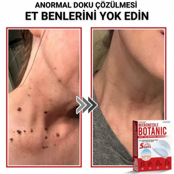 éLoura Mikro İğneli Ben Düşürücü Bant – 5 Günde İz Bırakmadan Düşürür