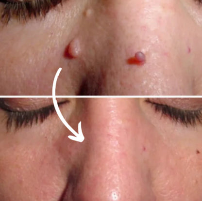 éLoura Mikro İğneli Ben Düşürücü Bant – 5 Günde İz Bırakmadan Düşürür