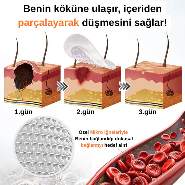 éLoura Mikro İğneli Ben Düşürücü Bant – 5 Günde İz Bırakmadan Düşürür