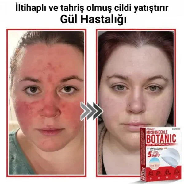 éLoura Mikro İğneli Ben Düşürücü Bant – 5 Günde İz Bırakmadan Düşürür