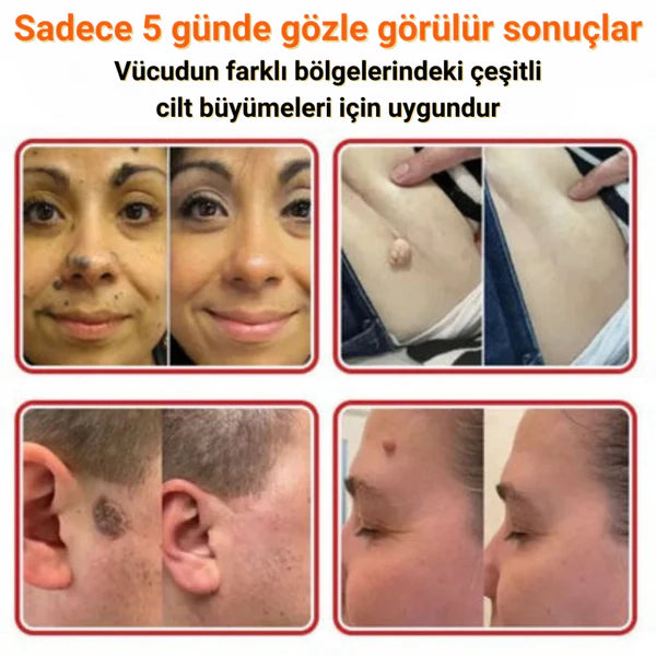 éLoura Mikro İğneli Ben Düşürücü Bant – 5 Günde İz Bırakmadan Düşürür