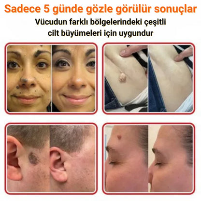 éLoura Mikro İğneli Ben Düşürücü Bant – 5 Günde İz Bırakmadan Düşürür