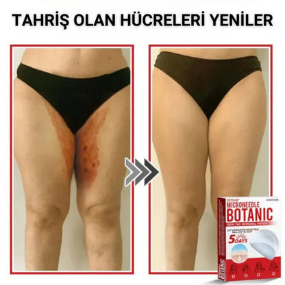 éLoura Mikro İğneli Ben Düşürücü Bant – 5 Günde İz Bırakmadan Düşürür